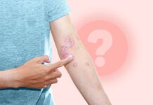 Ефективність лікування псоріазу: чому терапія може перестати працювати