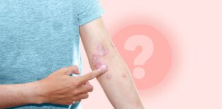 Ефективність лікування псоріазу: чому терапія може перестати працювати