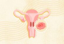 Рак шийки матки: розуміння симптомів, профілактика та лікування