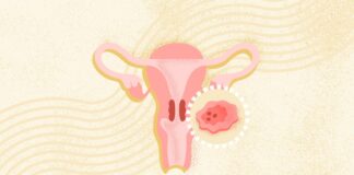 Рак шийки матки: розуміння симптомів, профілактика та лікування