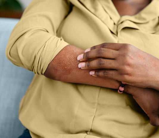 Переривання Замкнутого Кола: Коли Переглянути Лікування Екземи