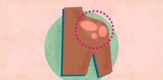 Псоріаз: Розуміння Симптомів, Причин та Методів Лікування